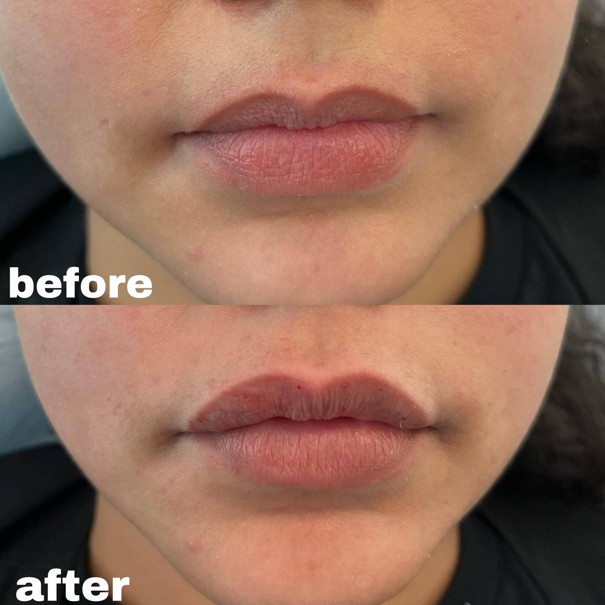 Case-1 30s female lip filler before and after Case-1 30s female lip filler before and after