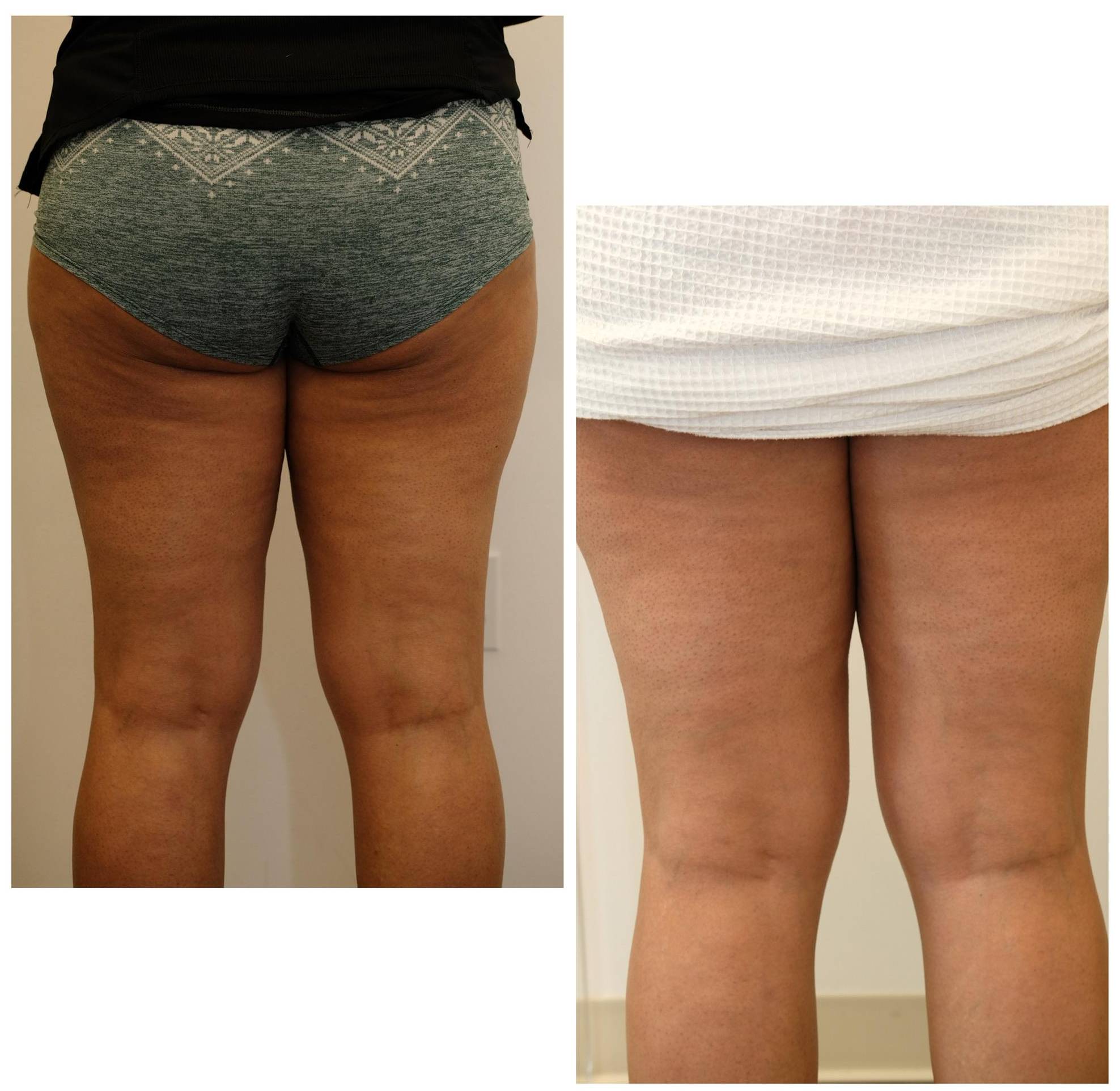 Case-4 30s Female Morpheus 8 Body before and after Case-4 30s Female Morpheus 8 Body before and after