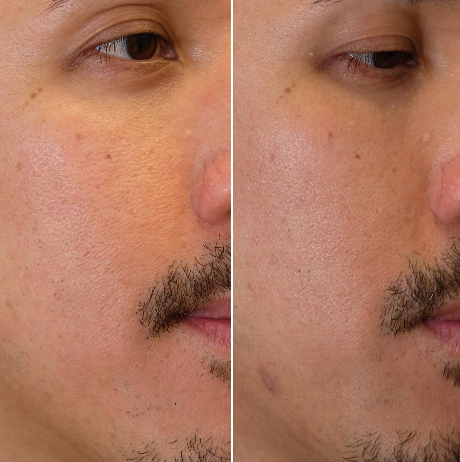 Case-5 40s male Morpheus 8 before and after Case-5 40s male Morpheus 8 before and after