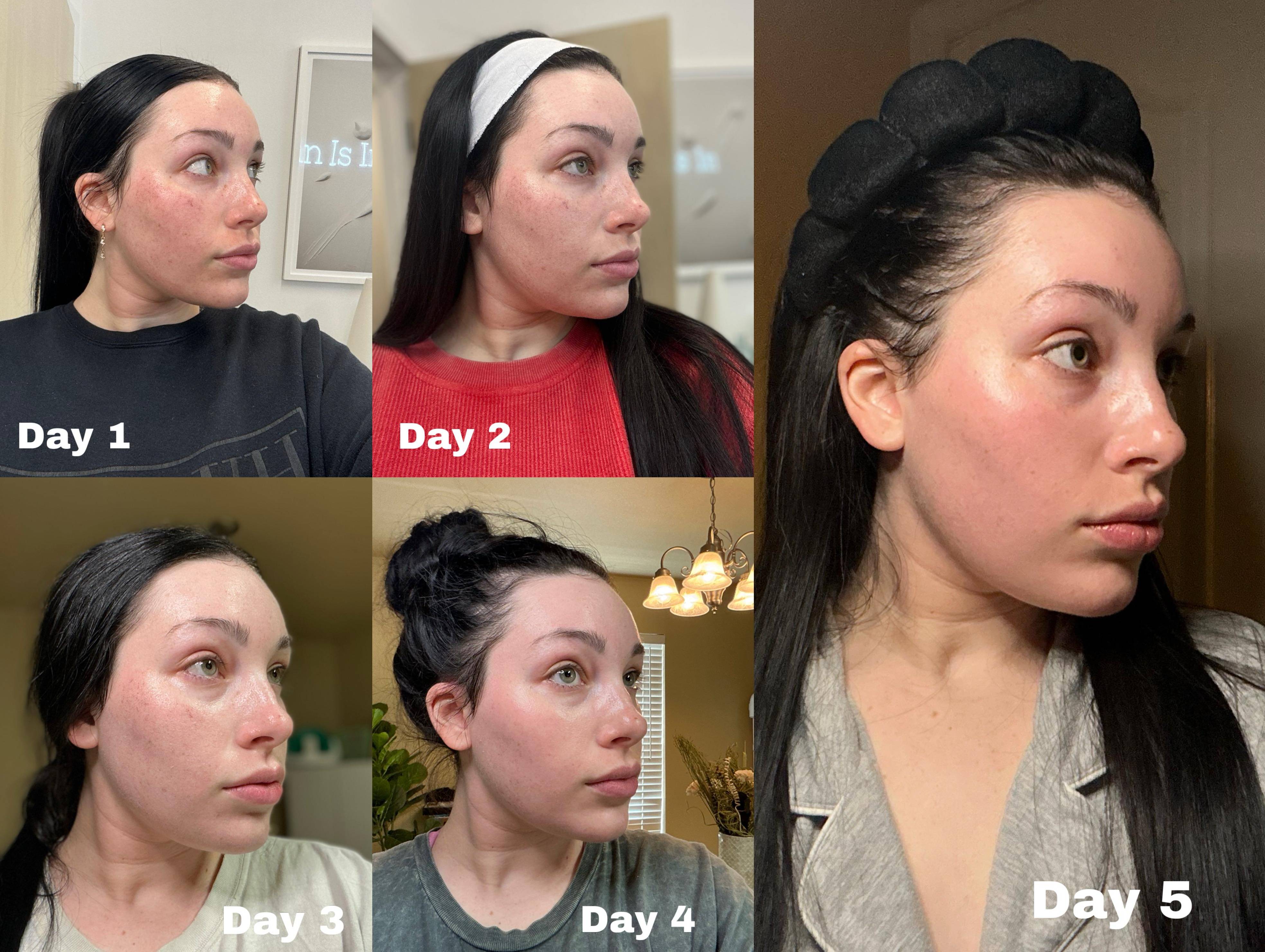 Case-1 20s Female Fraxel before and after Case-1 20s Female Fraxel before and after