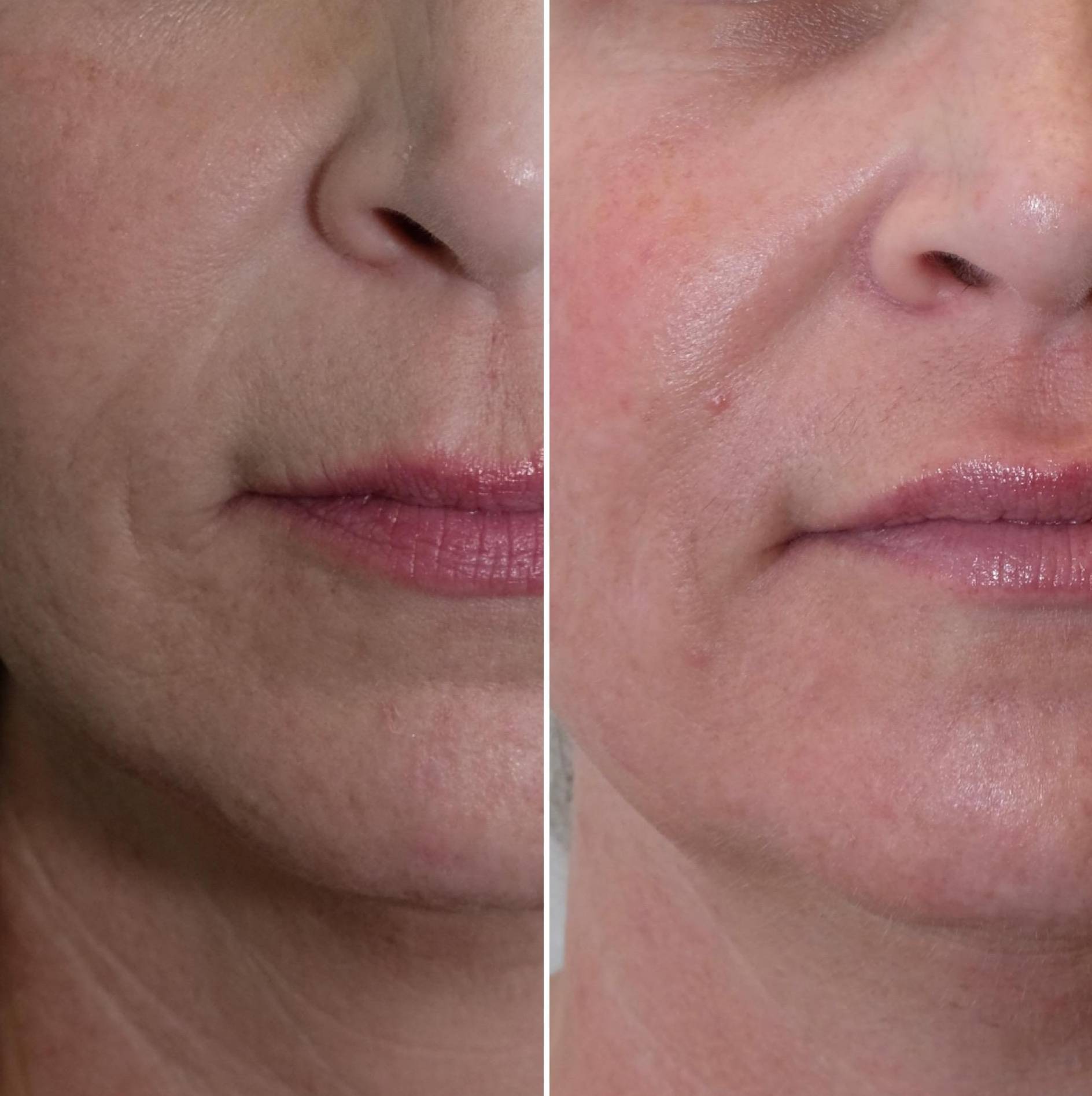 Case-6 50 Female Morpheus before and After Case-6 50 Female Morpheus before and After