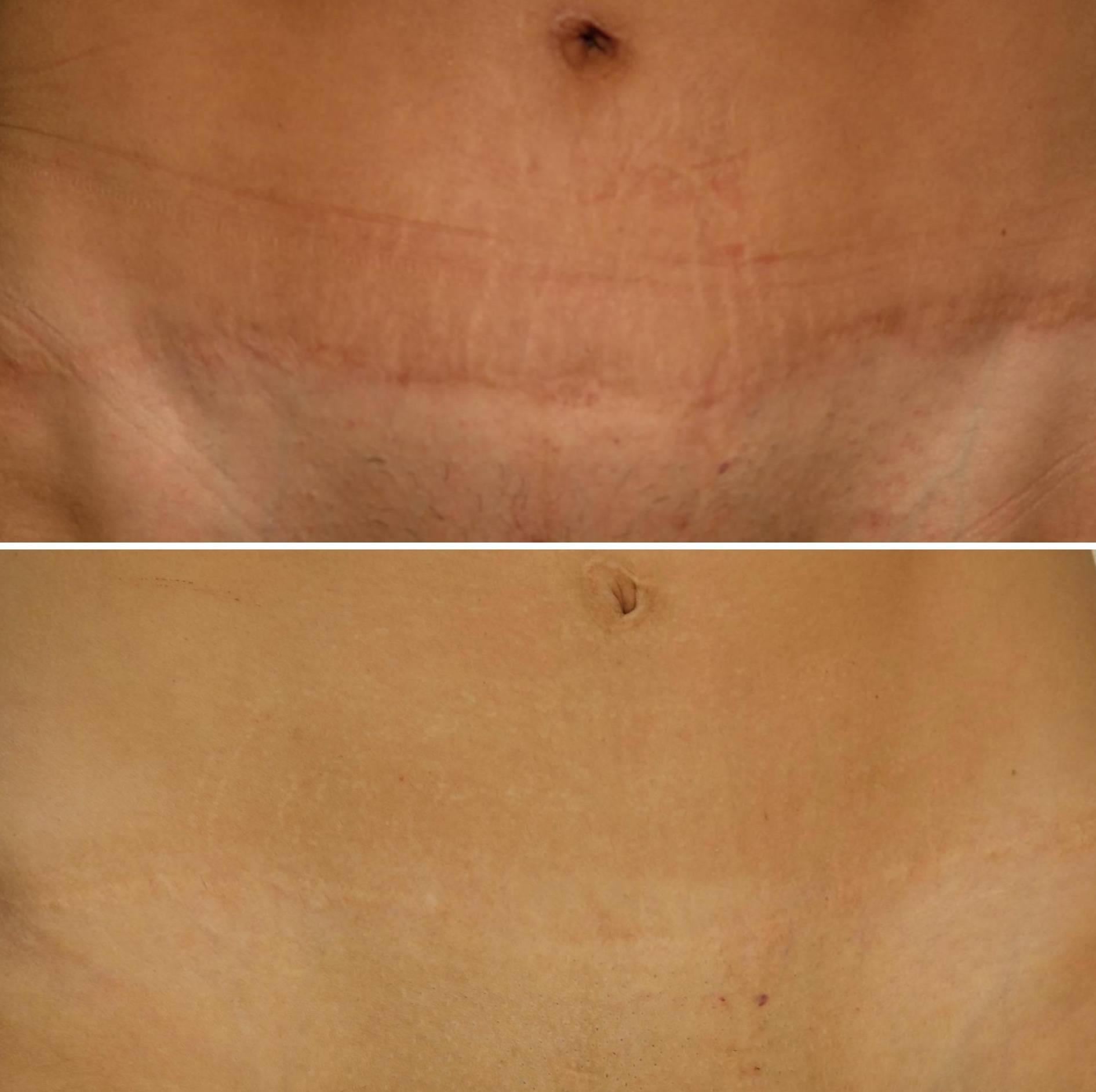 Case-1 50s female Morpheus 8 + Fraxel combo for tummy tuck scar Case-1 50s female Morpheus 8 + Fraxel combo for tummy tuck scar