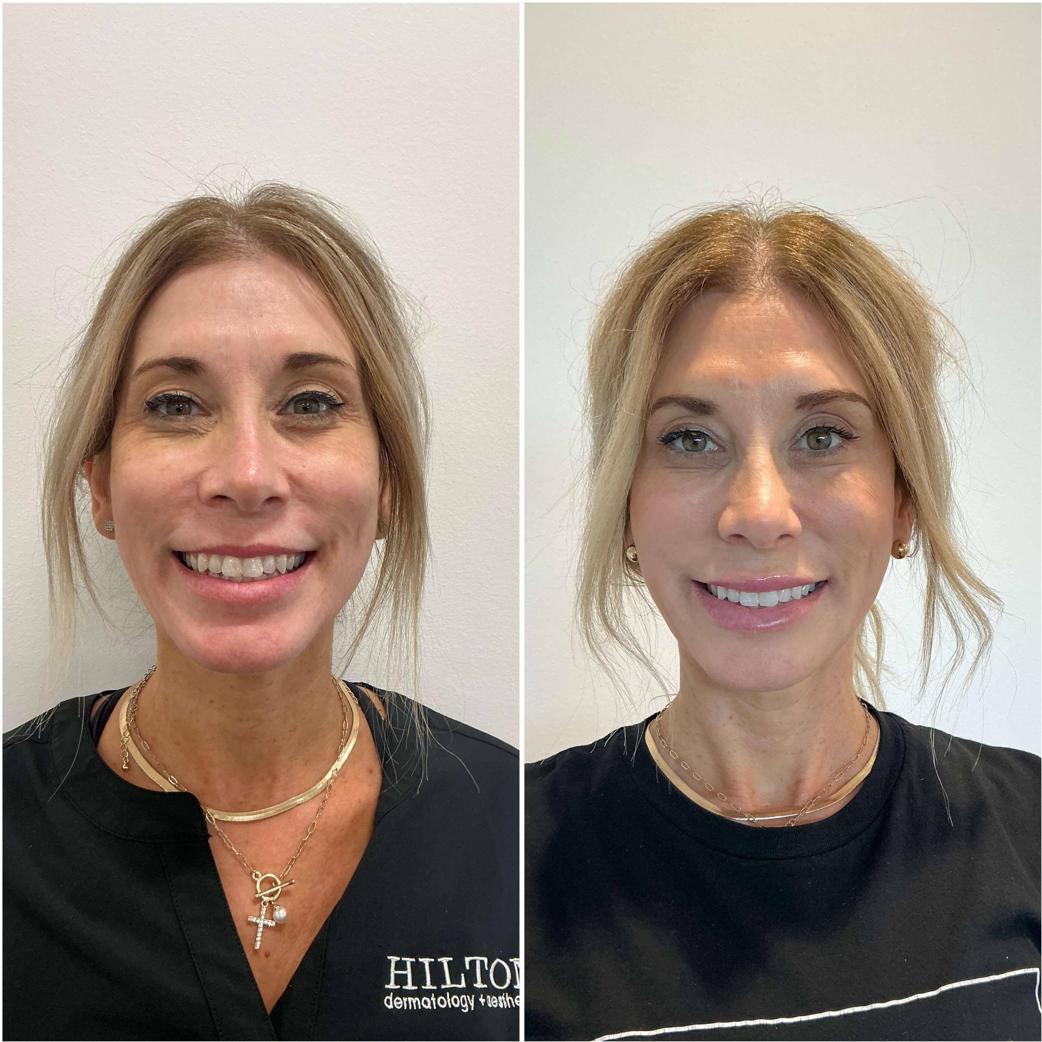 Case-1 40s female before and after filler + Sofwave Case-1 40s female before and after filler + Sofwave
