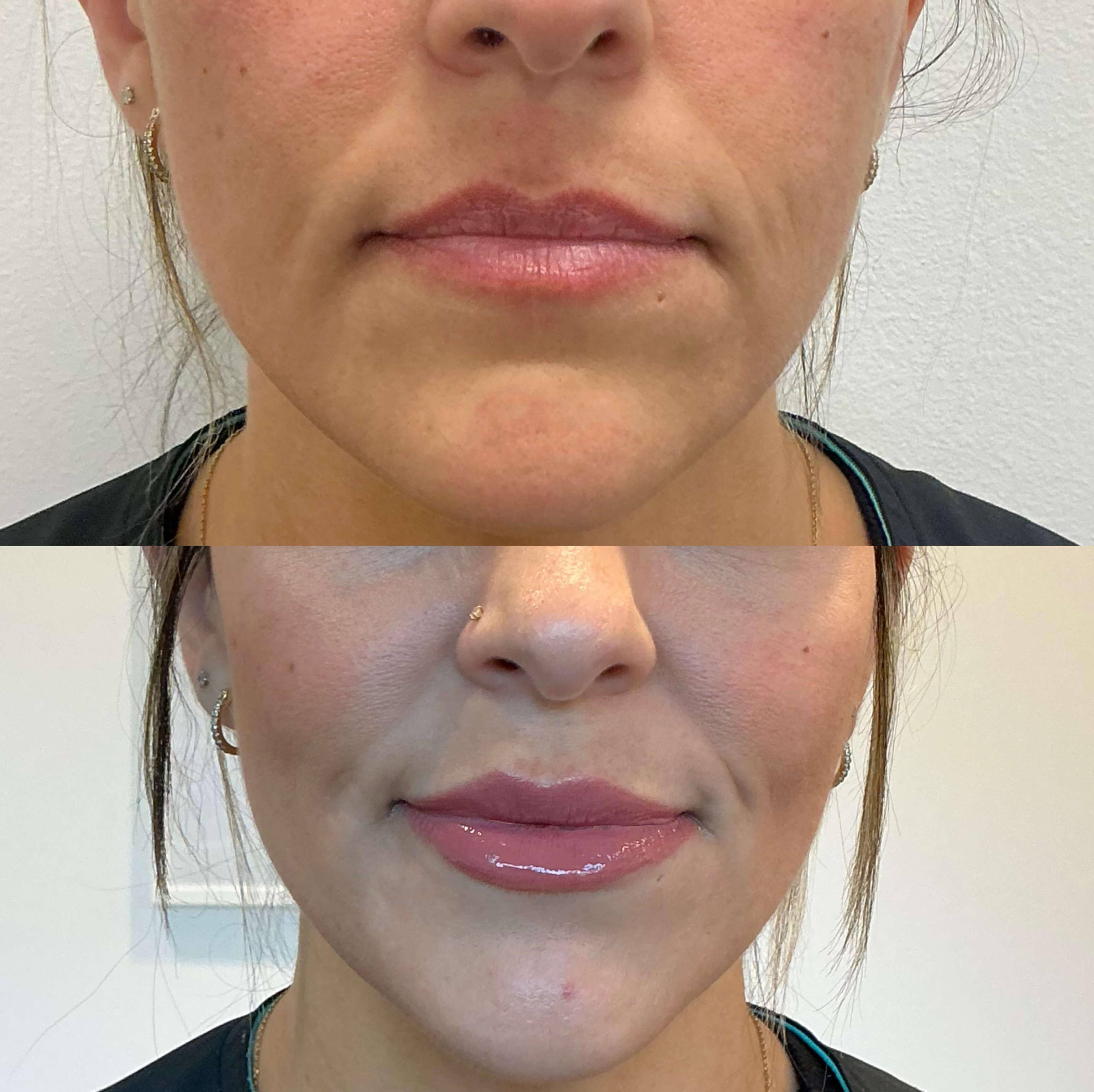 Case-2 30s female before and after lip filler. Case-2 30s female before and after lip filler.