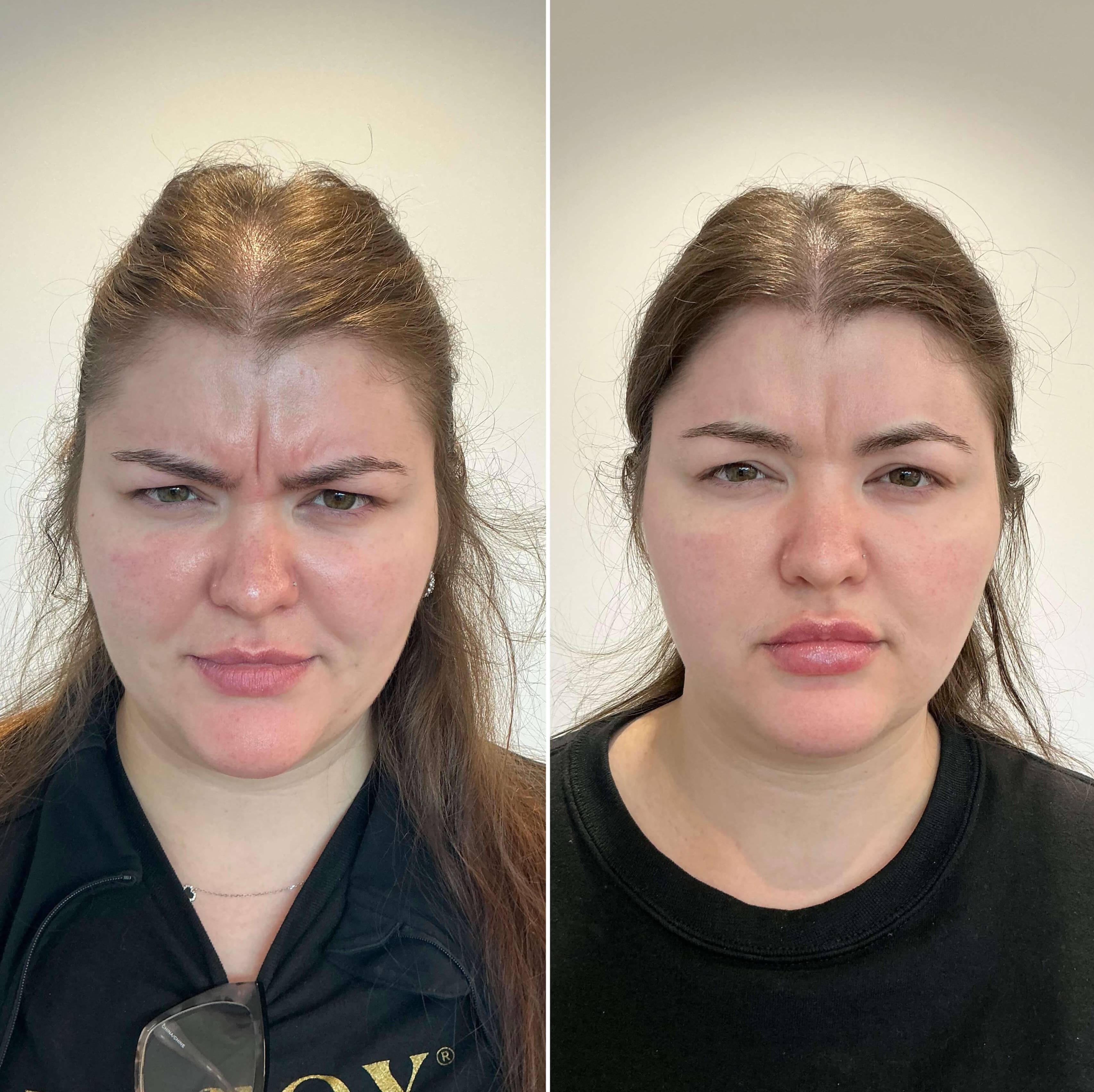 Case-2 20s female Jeaveau/ Lip filler before and after. Case-2 20s female Jeaveau/ Lip filler before and after.