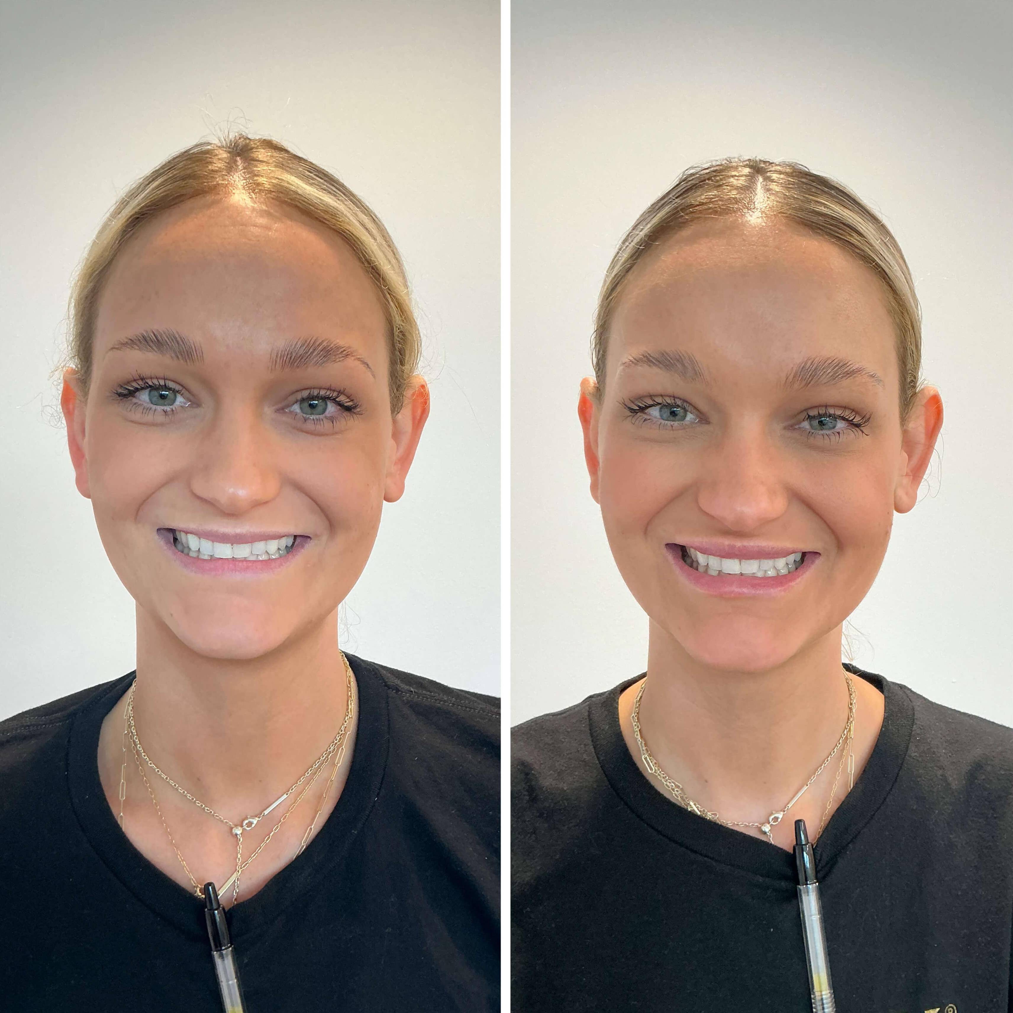 Case-3 20 Female before and after lip filler Case-3 20 Female before and after lip filler