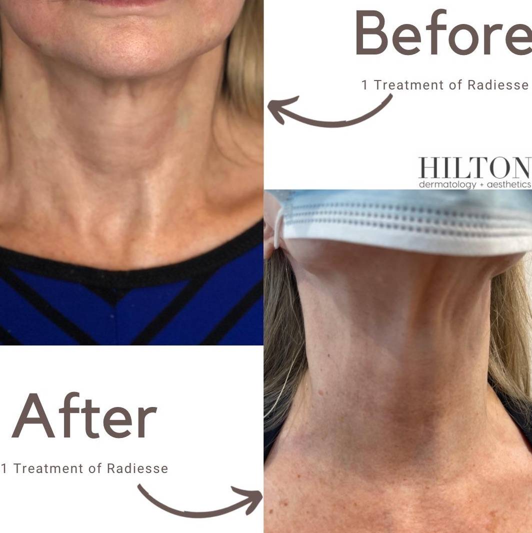 Case-1 70s female before and after filler Case-1 70s female before and after filler
