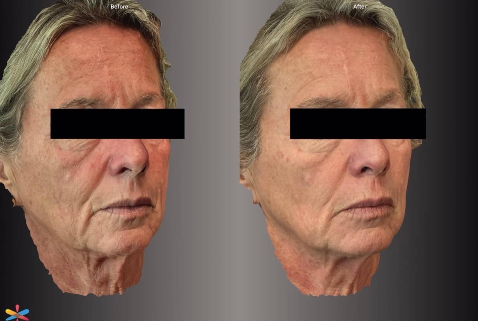 Case-1 60s female Vbeam before and after Case-1 60s female Vbeam before and after