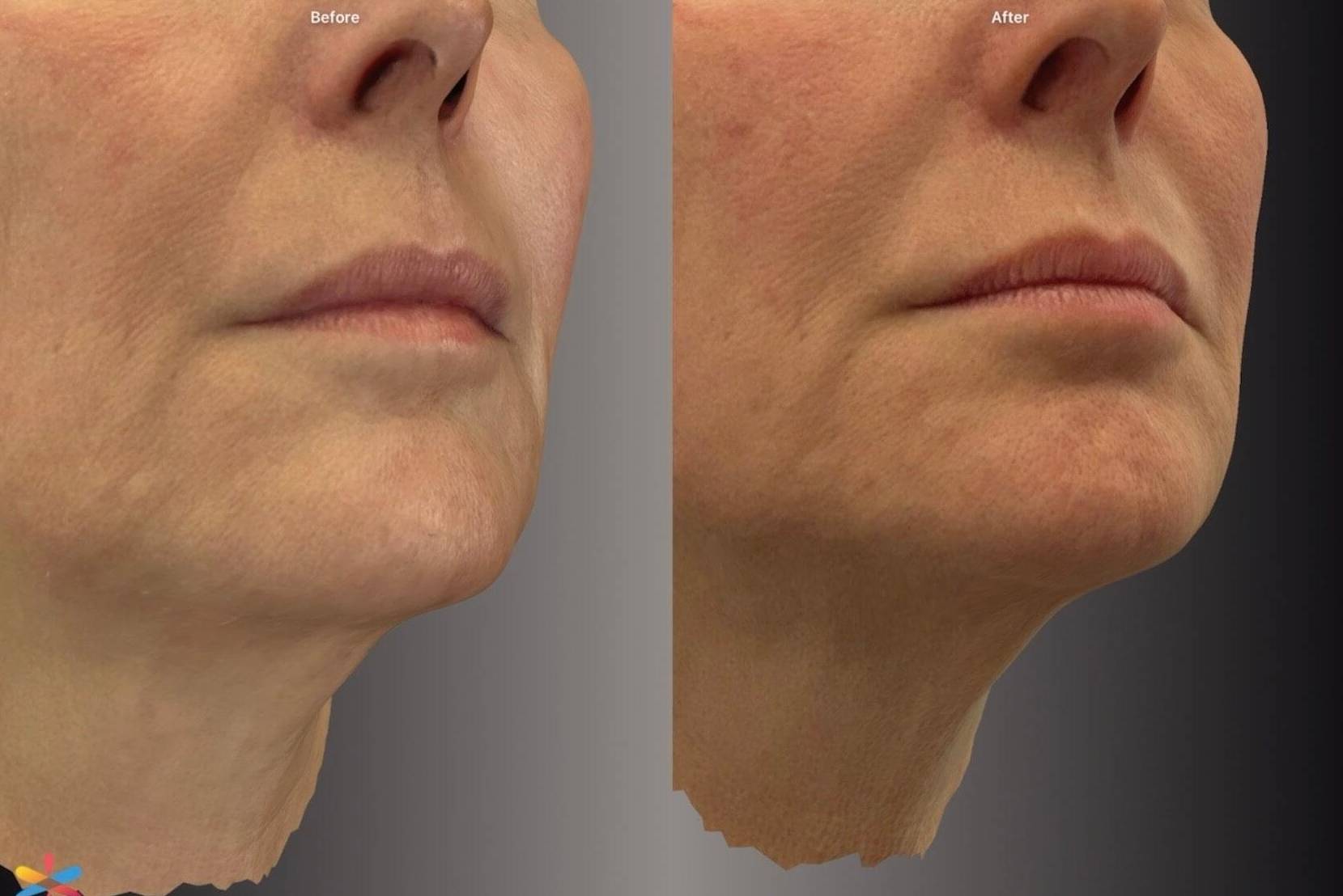 Case-01 50s female before and after Sofwave Case-01 50s female before and after Sofwave