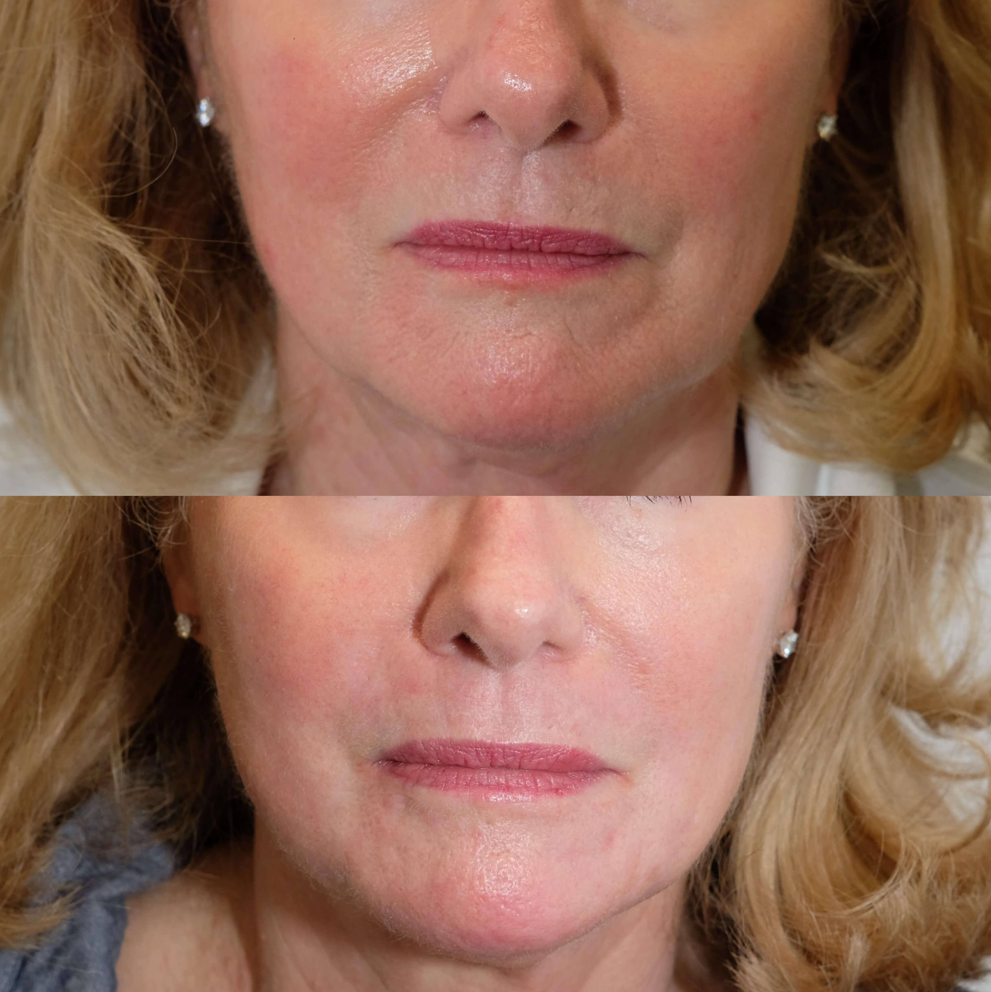 Case-01 60s before and after CO2 laser. Case-01 60s before and after CO2 laser.
