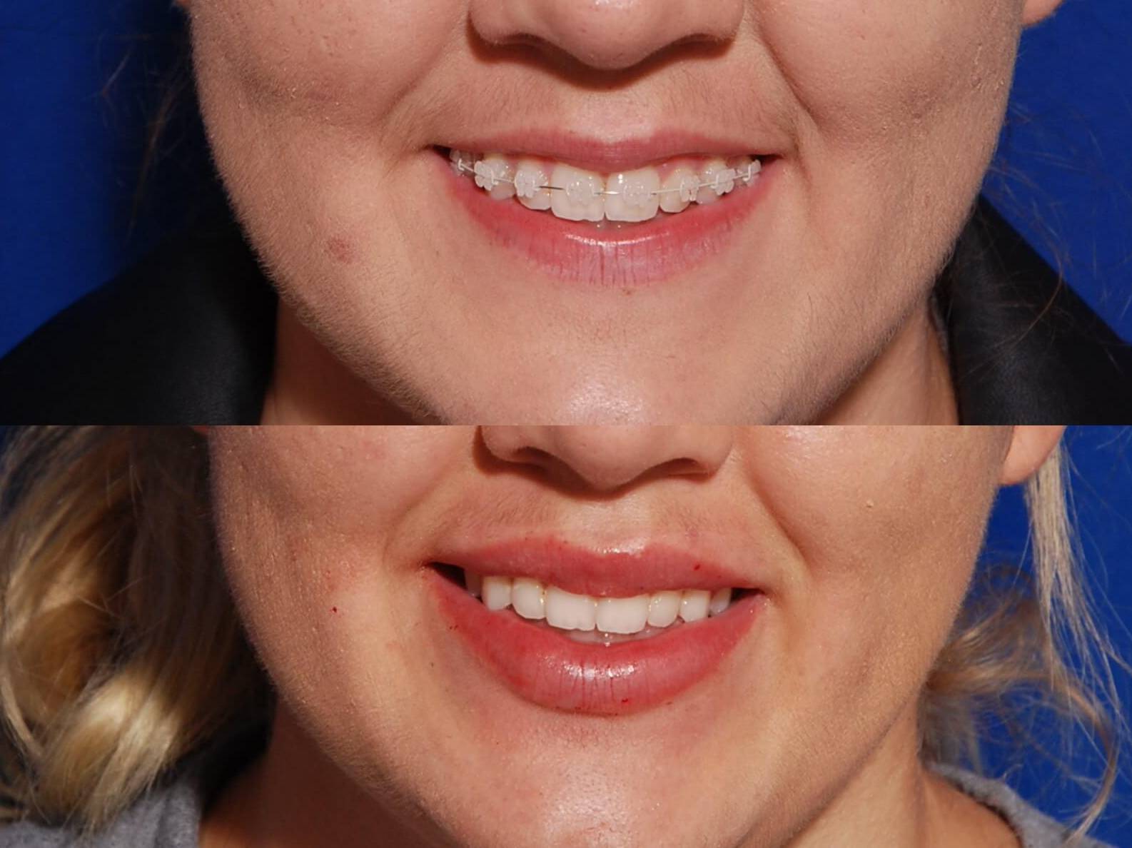 Case-01 30s before and after lip rejevenation Case-01 30s before and after lip rejevenation