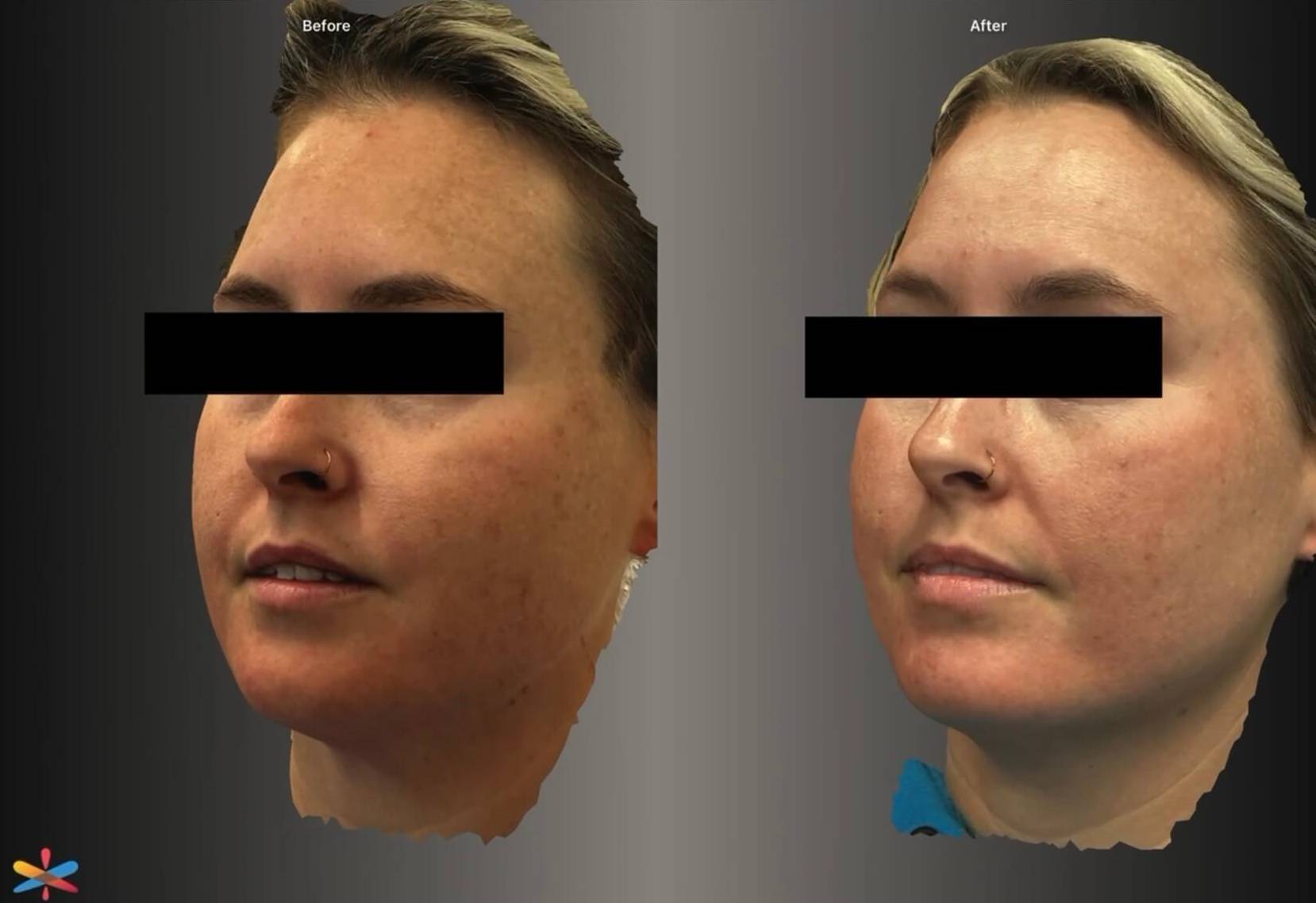 Case-03 Before and after Fraxel laser treatment Case-03 Before and after Fraxel laser treatment
