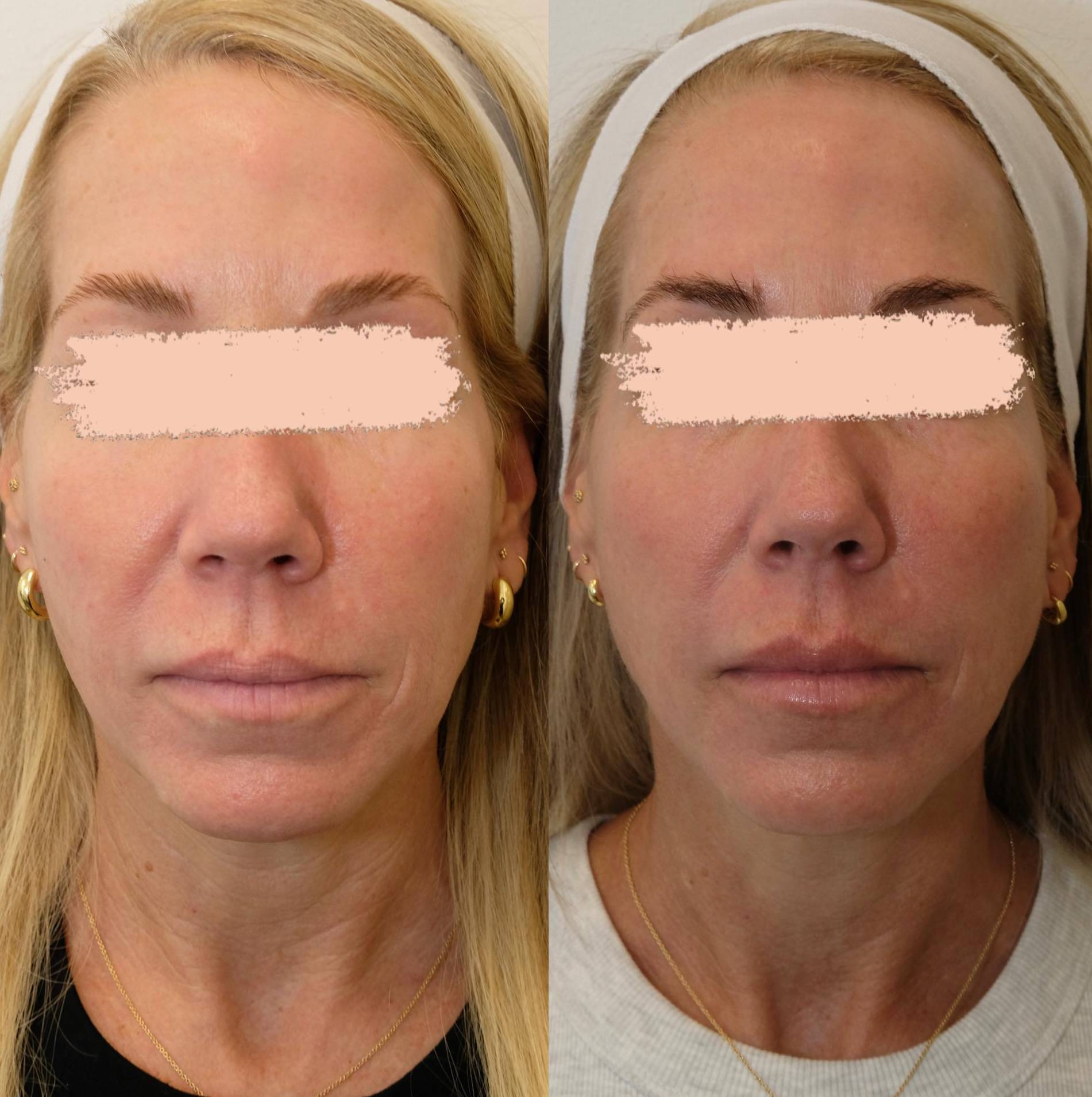 Case-1 40s female Morpheus before and after Case-1 40s female Morpheus before and after