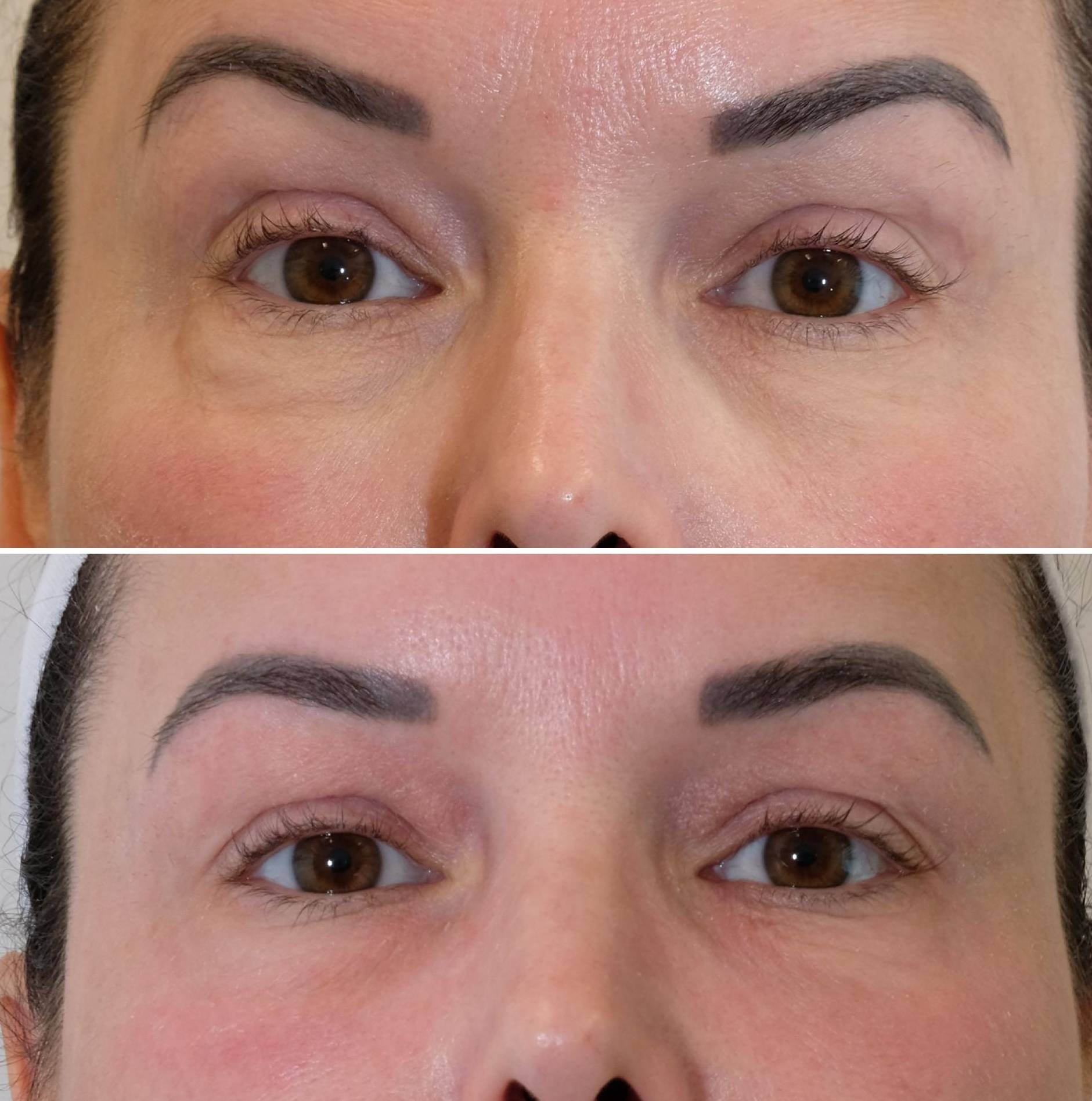 Case-2 50s Female Morpheus before and after Case-2 50s Female Morpheus before and after