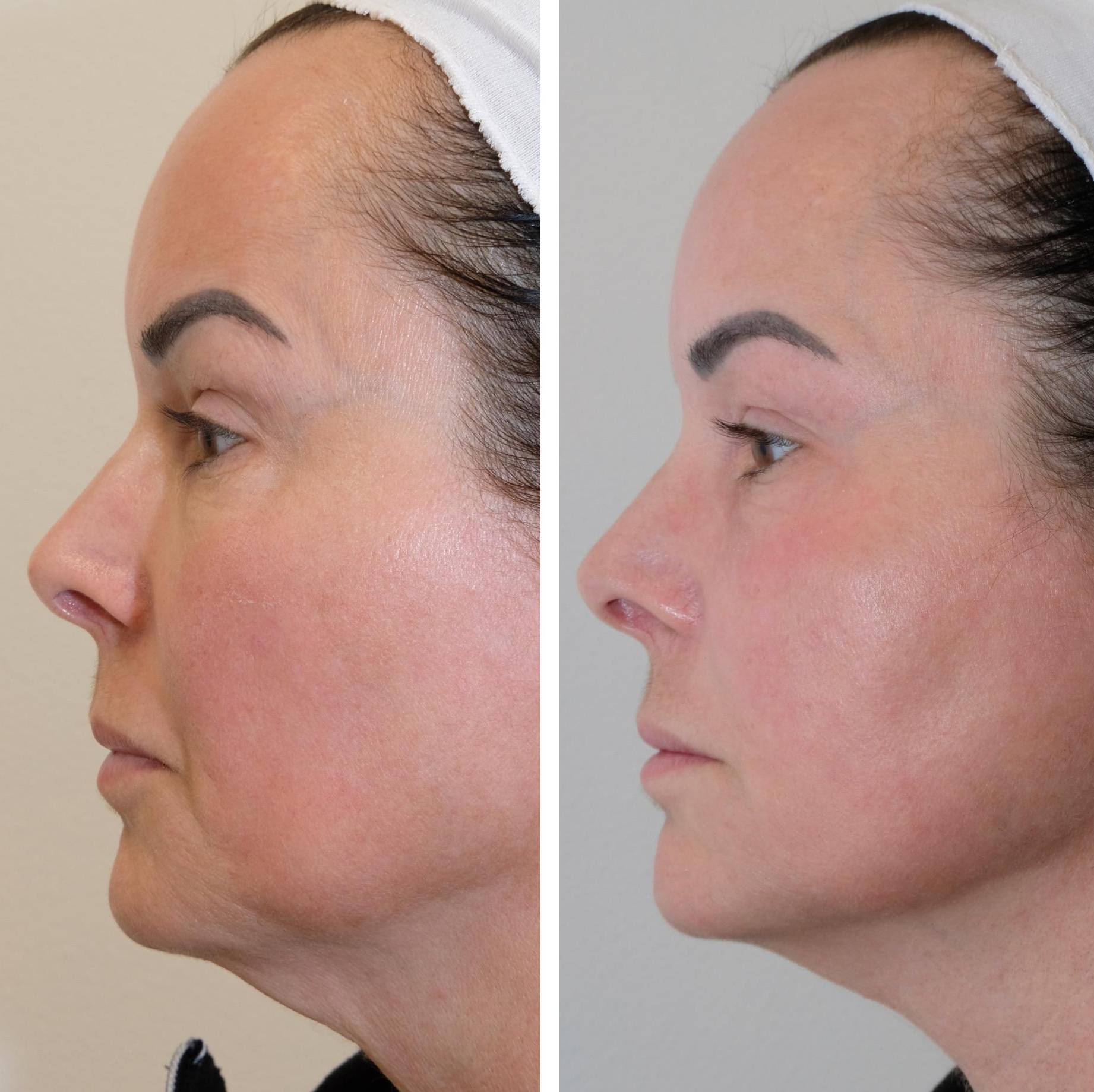 Case-3 50s Female Morpheus before and after Case-3 50s Female Morpheus before and after