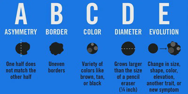 Atypical Melanocytic Lesion ABCDEs of Melanoma Skin Cancer and Reconstructive Surgery Center Orange County 4042323