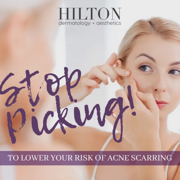 PREVENT ACNE SCARRING 600x600 3999633