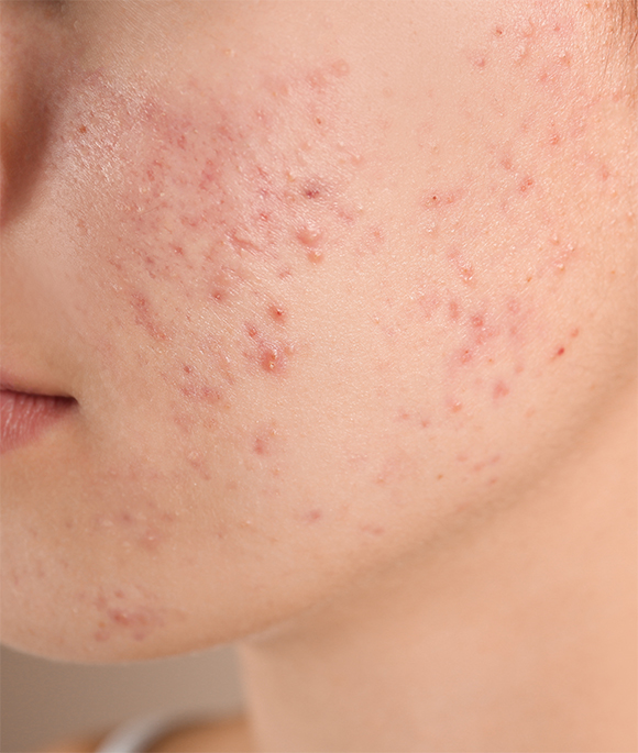 ACNE