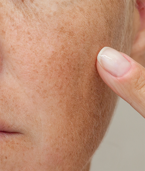 PIGMENTARY DISORDERS