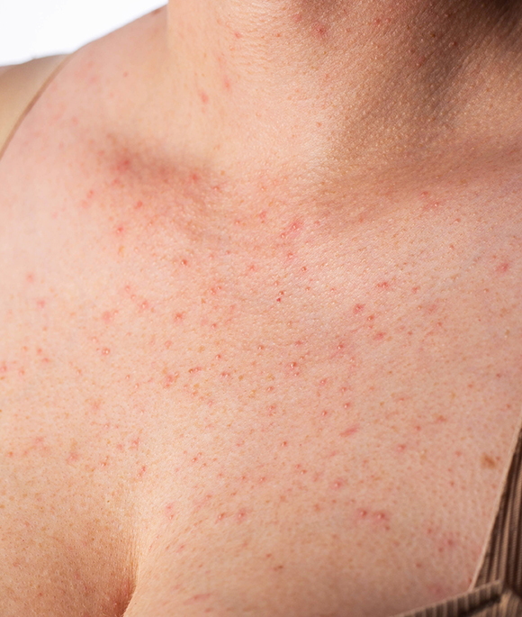 SKIN INFECTIONS